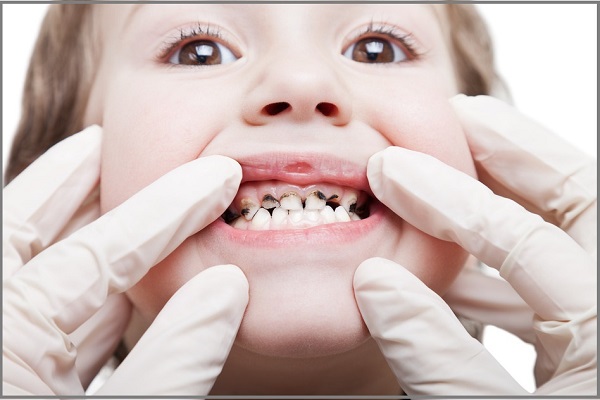 cham soc rang mieng cho tre.jpg1  - 6 sai lầm cần tránh khi chăm sóc răng miệng cho trẻ